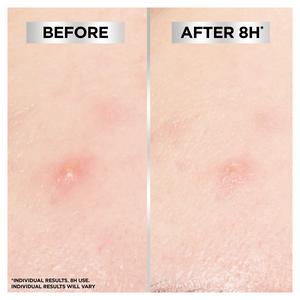 Garnier 8H Invisible Blemish Patches for Spots x44 - gallery image 5