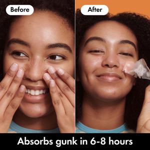 Hero Mighty Patch Hydrocolloid Nose Patches x10 - gallery image 4